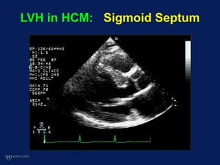 LVH in HCM: Sigmoid Septum
 