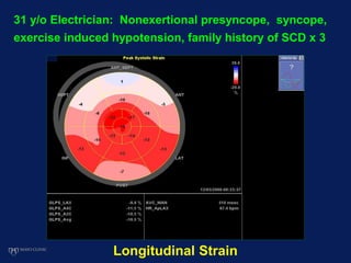 Longitudinal Strain
31 y/o Electrician: Nonexertional presyncope, syncope,
exercise induced hypotension, family history of SCD x 3
 