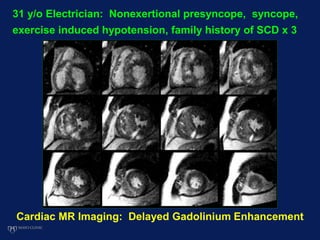 Cardiac MR Imaging: Delayed Gadolinium Enhancement
31 y/o Electrician: Nonexertional presyncope, syncope,
exercise induced hypotension, family history of SCD x 3
 