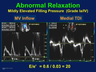 Abnormal Relaxation
Mildly Elevated Filling Pressure (Grade Ia/IV)
MV Inflow Medial TDI
E/e' = 0.6 / 0.03 = 20
 