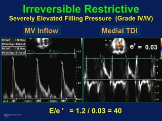 Irreversible Restrictive
Severely Elevated Filling Pressure (Grade IV/IV)
e' = 0.03
E/e ' = 1.2 / 0.03 = 40
MV Inflow Medial TDI
 