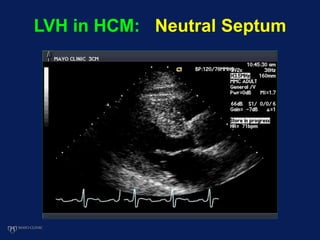 LVH in HCM: Neutral Septum
 