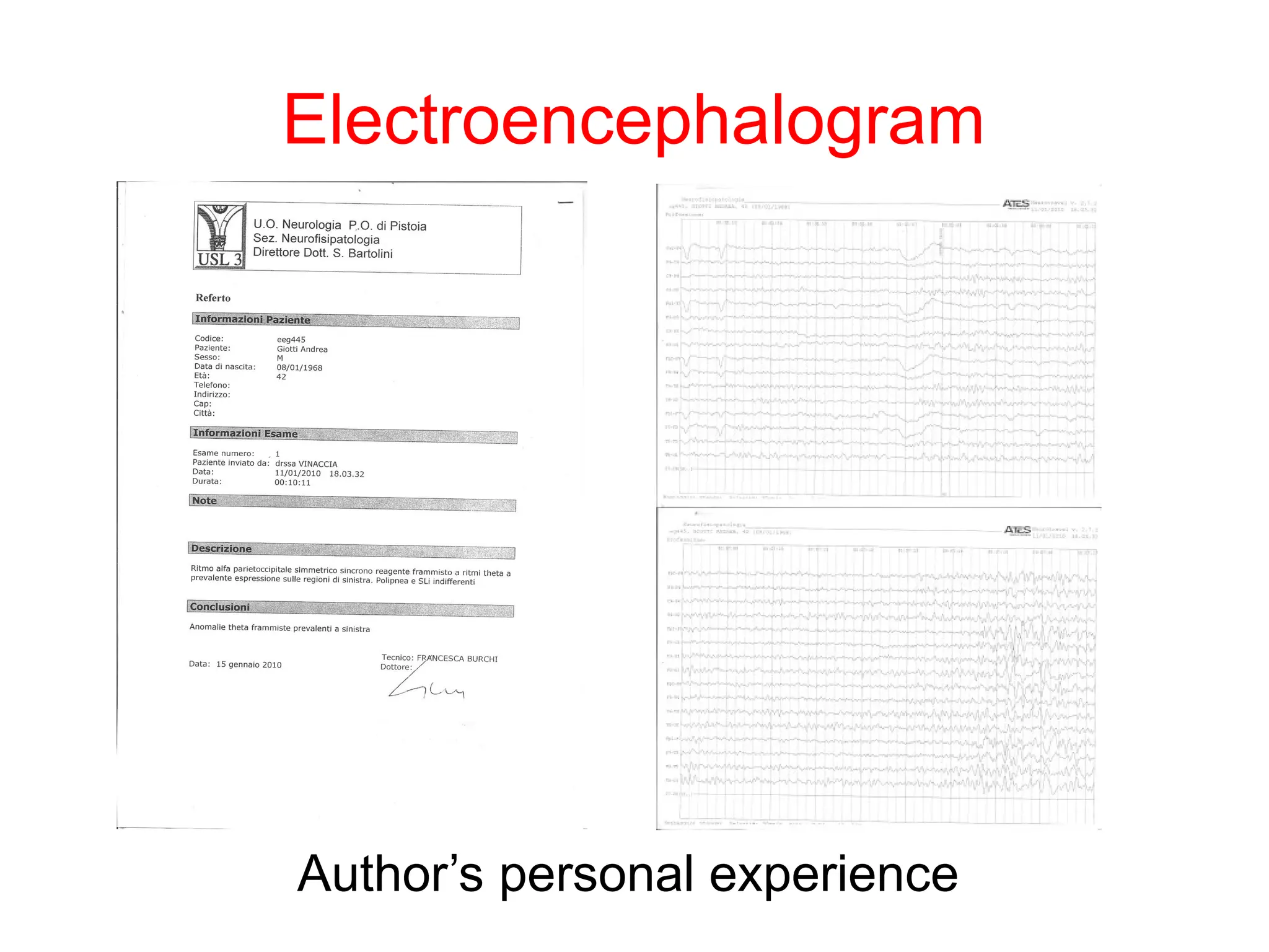 Author’s personal experience
Electroencephalogram
 