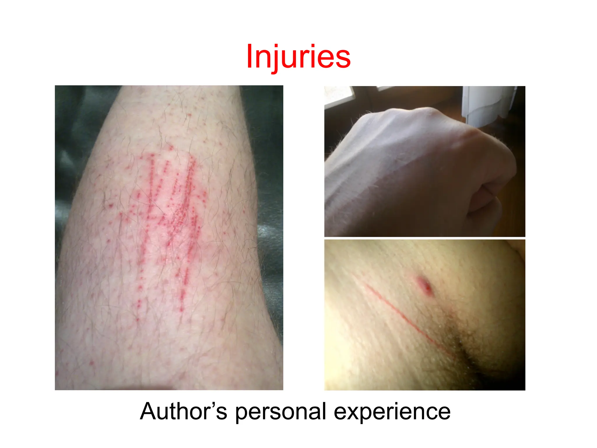 Author’s personal experience
Injuries
 