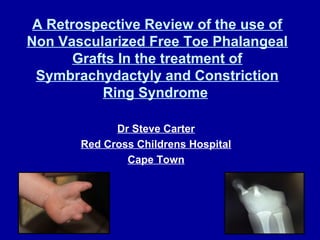 A Retrospective Review of the use of 
Non Vascularized Free Toe Phalangeal 
Grafts In the treatment of 
Symbrachydactyly and Constriction 
Ring Syndrome 
Dr Steve Carter 
Red Cross Childrens Hospital 
Cape Town 
 