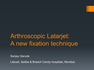 Arthroscopic Latarjet: 
A new fixation technique 
Sanjay Garude 
Lilavati, Saifee & Breach Candy hospitals; Mumbai. 
 