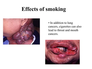Effects of smoking
• In addition to lung
cancers, cigarettes can also
lead to throat and mouth
cancers.
 