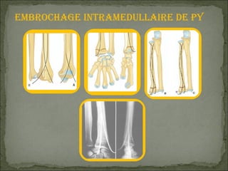 Embrochage intramedullaire de PY 
