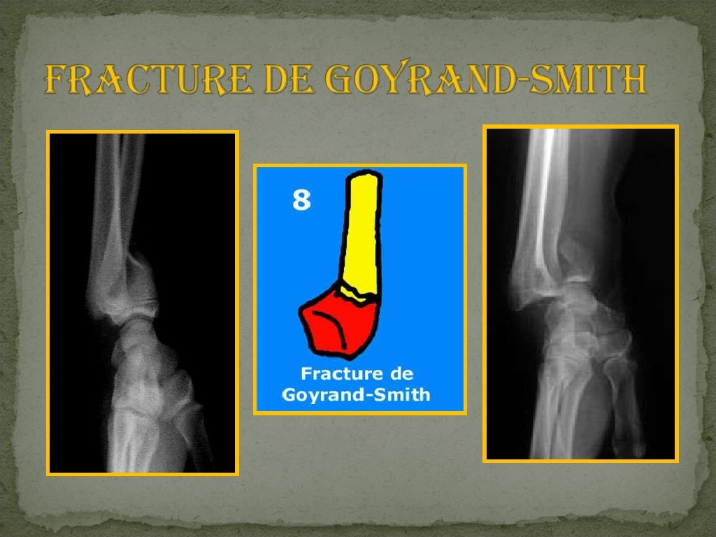 Suite De Fracture En 3 Lettres
