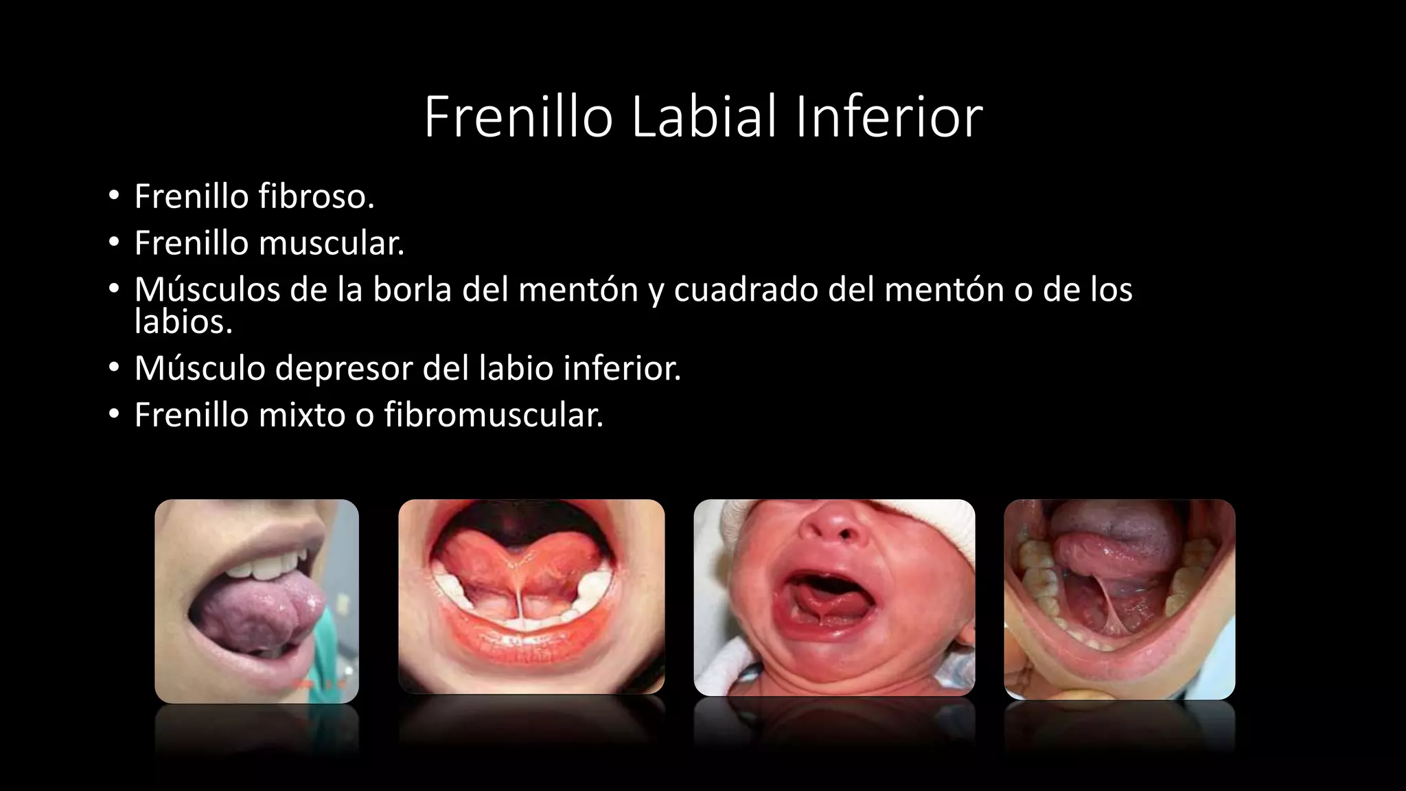 Frenillo Labial Inferior
• Frenillo fibroso.
• Frenillo muscular.
• Músculos de la borla del mentón y cuadrado del mentón o de los
labios.
• Músculo depresor del labio inferior.
• Frenillo mixto o fibromuscular.
 