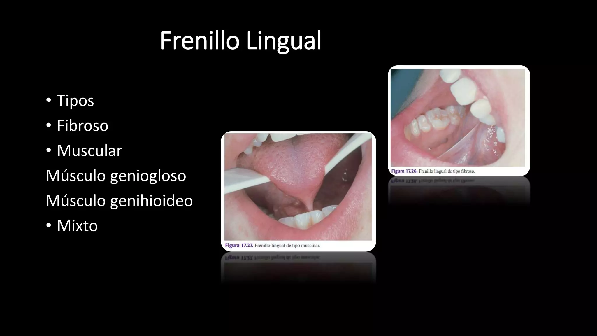 Frenillo Lingual
• Tipos
• Fibroso
• Muscular
Músculo geniogloso
Músculo genihioideo
• Mixto
 
