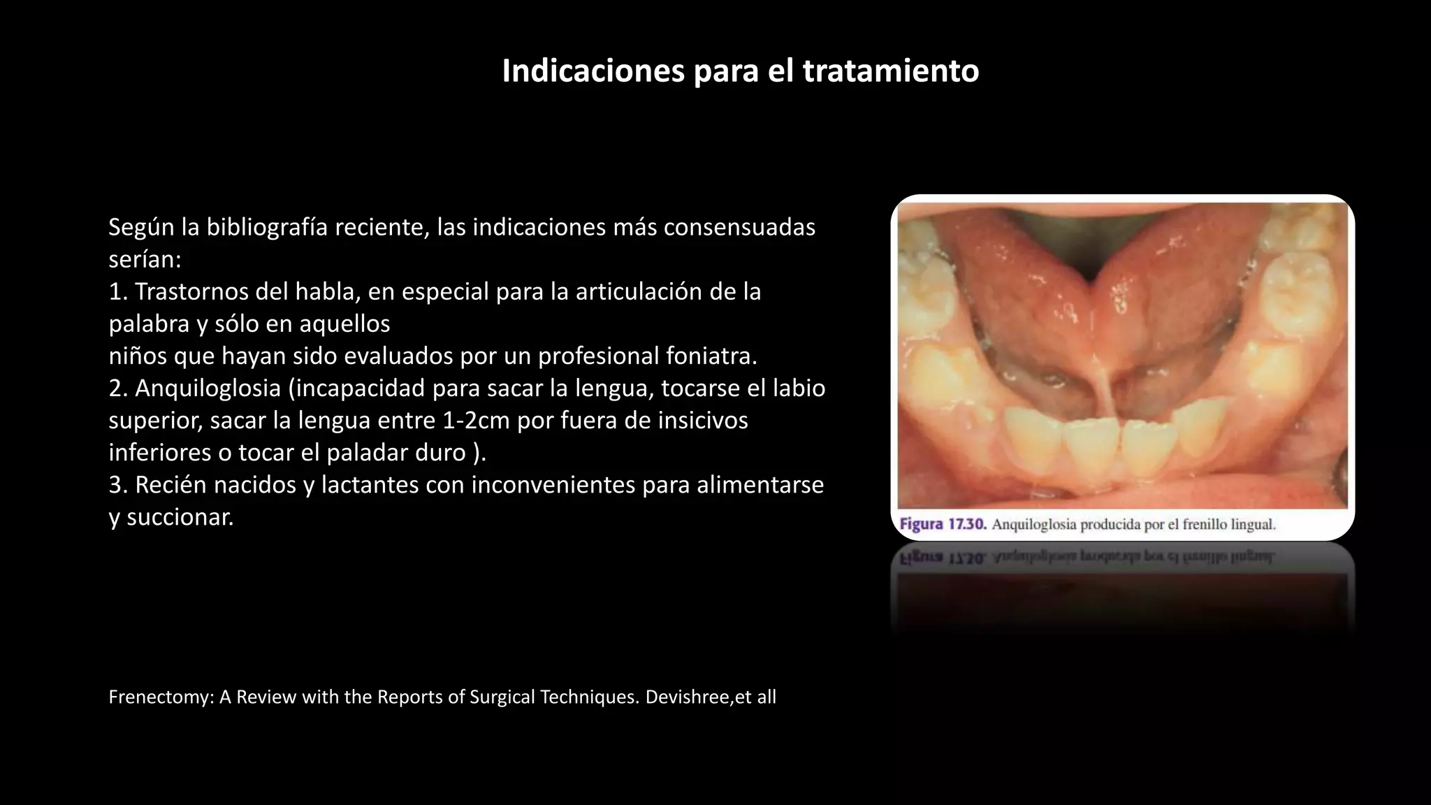 Frenectomy: A Review with the Reports of Surgical Techniques. Devishree,et all
Según la bibliografía reciente, las indicaciones más consensuadas
serían:
1. Trastornos del habla, en especial para la articulación de la
palabra y sólo en aquellos
niños que hayan sido evaluados por un profesional foniatra.
2. Anquiloglosia (incapacidad para sacar la lengua, tocarse el labio
superior, sacar la lengua entre 1-2cm por fuera de insicivos
inferiores o tocar el paladar duro ).
3. Recién nacidos y lactantes con inconvenientes para alimentarse
y succionar.
Indicaciones para el tratamiento
 