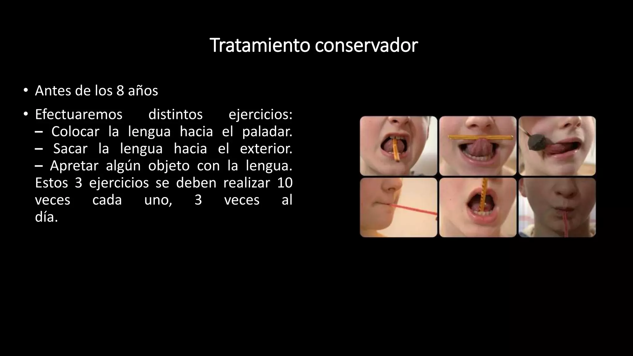 Tratamiento conservador
• Antes de los 8 años
• Efectuaremos distintos ejercicios:
– Colocar la lengua hacia el paladar.
– Sacar la lengua hacia el exterior.
– Apretar algún objeto con la lengua.
Estos 3 ejercicios se deben realizar 10
veces cada uno, 3 veces al
día.
 