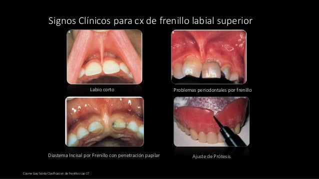 Frenillos Bucales Frenillos Bucales