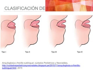 Frenectomía hernan molina | PPTX