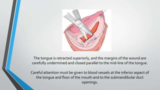 The tongue is retracted superiorly, and the margins of the wound are
carefully undermined and closed parallel to the mid-l...