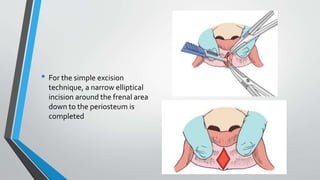 • For the simple excision
technique, a narrow elliptical
incision around the frenal area
down to the periosteum is
complet...