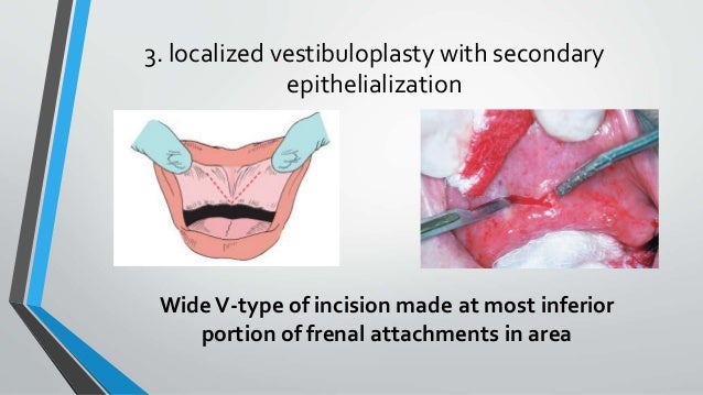 lingual frenectomy