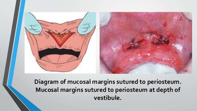 lingual frenectomy
