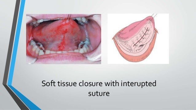 lingual frenectomy