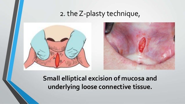 lingual frenectomy