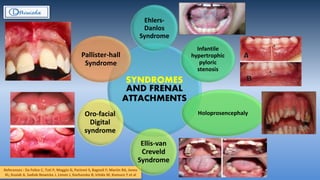 References : Da Felice C, Toti P, Maggio G, Parinmi S, Bagnoli F; Martin RA, Jones
KL; Kusiak A, Sadiak-Nowicka J, Limon J, Kochanska B; Ichida M, Komuro Y et al
SYNDROMES
AND FRENAL
ATTACHMENTS
Ehlers-
Danlos
Syndrome
Infantile
hypertrophic
pyloric
stenosis
Holoprosencephaly
Ellis-van
Creveld
Syndrome
Oro-facial
Digital
syndrome
Pallister-hall
Syndrome
 