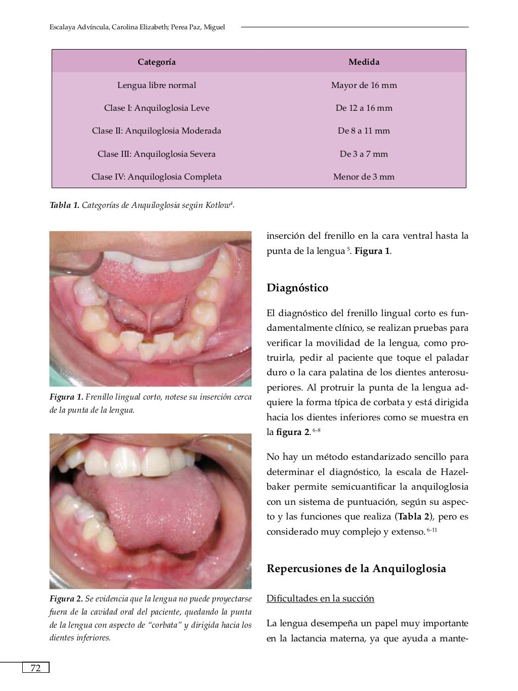 Ejercicios Frenillo Lingual Corto Bebé Frenillo lingual