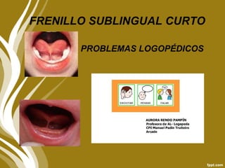 FRENILLO SUBLINGUAL CURTO
PROBLEMAS LOGOPÉDICOS
 
