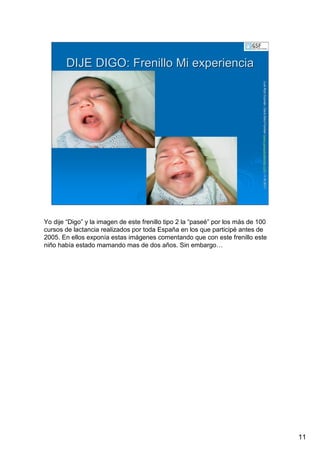 11
LuisRuizGuzmLuisRuizGuzmáán,n,GavGavààSalutSalutFamiliar(Familiar(www.gavasalutfamiliar.comwww.gavasalutfamiliar.com)11)11--XIXI--20112011
DIJE DIGO: Frenillo Mi experienciaDIJE DIGO: Frenillo Mi experiencia
Yo dije “Digo” y la imagen de este frenillo tipo 2 la “paseé” por los más de 100
cursos de lactancia realizados por toda España en los que participé antes de
2005. En ellos exponía estas imágenes comentando que con este frenillo este
niño había estado mamando mas de dos años. Sin embargo…
 