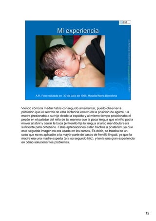 12
LuisRuizGuzmLuisRuizGuzmáán,n,GavGavààSalutSalutFamiliar(Familiar(www.gavasalutfamiliar.comwww.gavasalutfamiliar.com)11)11--XIXI--20112011
Mi experienciaMi experiencia
A.R. Foto realizada en 30 de Julio de 1998. Hospital Nens Barcelona
Viendo cómo la madre había conseguido amamantar, puedo observar a
posteriori que el secreto de esta lactancia estuvo en la posición de agarre. La
madre presionaba a su hijo desde la espalda y al mismo tiempo posicionaba el
pezón en el paladar del niño de tal manera que la poca lengua que el niño podía
mover al abrir y cerrar la boca (el frenillo fija la lengua al arco mandibular) era
suficiente para ordeñarlo. Estas apreciaciones están hechas a posteriori, ya que
esta segunda imagen no era usada en los cursos. Es decir, se trataba de un
caso que no es aplicable a la mayor parte de casos de frenillo lingual, ya que la
madre era una madre experta (era su segundo hijo), y tenía una gran experiencia
en cómo solucionar los problemas.
 