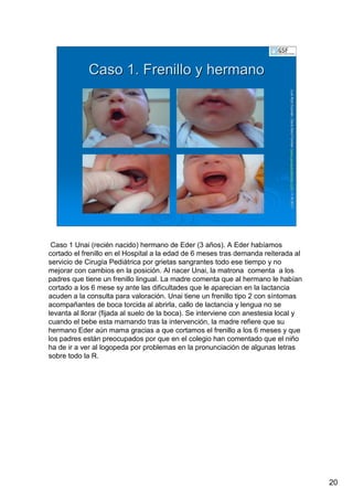 20
LuisRuizGuzmLuisRuizGuzmáán,n,GavGavààSalutSalutFamiliar(Familiar(www.gavasalutfamiliar.comwww.gavasalutfamiliar.com)11)11--XIXI--20112011
Caso 1. Frenillo y hermanoCaso 1. Frenillo y hermano
Caso 1 Unai (recién nacido) hermano de Eder (3 años). A Eder habíamos
cortado el frenillo en el Hospital a la edad de 6 meses tras demanda reiterada al
servicio de Cirugía Pediátrica por grietas sangrantes todo ese tiempo y no
mejorar con cambios en la posición. Al nacer Unai, la matrona comenta a los
padres que tiene un frenillo lingual. La madre comenta que al hermano le habían
cortado a los 6 mese sy ante las dificultades que le aparecian en la lactancia
acuden a la consulta para valoración. Unai tiene un frenillo tipo 2 con síntomas
acompañantes de boca torcida al abrirla, callo de lactancia y lengua no se
levanta al llorar (fijada al suelo de la boca). Se interviene con anestesia local y
cuando el bebe esta mamando tras la intervención, la madre refiere que su
hermano Eder aún mama gracias a que cortamos el frenillo a los 6 meses y que
los padres están preocupados por que en el colegio han comentado que el niño
ha de ir a ver al logopeda por problemas en la pronunciación de algunas letras
sobre todo la R.
 