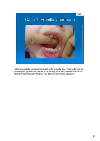 21
LuisRuizGuzmLuisRuizGuzmáán,n,GavGavààSalutSalutFamiliar(Familiar(www.gavasalutfamiliar.comwww.gavasalutfamiliar.com)11)11--XIXI--20112011
Caso 1. Frenillo y hermanoCaso 1. Frenillo y hermano
Habiamos cortado suficientemente el frenillo lingual a Eder Para poder mamar
pero no para generar dificultades en el habal y en la denticion con la rotacion
interna de los incisivos inferiores. Fue derivado al cirujano pediatrico.
 
