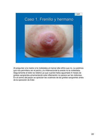 22
LuisRuizGuzmLuisRuizGuzmáán,n,GavGavààSalutSalutFamiliar(Familiar(www.gavasalutfamiliar.comwww.gavasalutfamiliar.com)11)11--XIXI--20112011
Caso 1. Frenillo y hermanoCaso 1. Frenillo y hermano
Al preguntar a la madre si le molestaba al mamar ella refirio que no. Le pedimos
que nos permitiera ver el pecho y la infalmacionde la areola no le molestaba.
Seguramente el dolor es relativo ya que cuando habia aguantado 6 meses de
grietas sangrantes amamantando esta inflamación no parece ser tan dolorosa.
En el centro del pezón se aprecian las cicatrices de las grietas sangrantes antes
de la operación de Eder.
 
