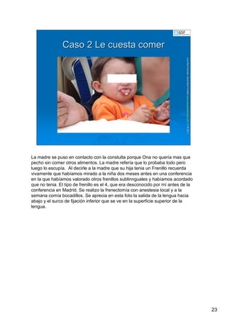 23
LuisRuizGuzmLuisRuizGuzmáán,n,GavGavààSalutSalutFamiliar(Familiar(www.gavasalutfamiliar.comwww.gavasalutfamiliar.com)11)11--XIXI--20112011
Caso 2 Le cuesta comerCaso 2 Le cuesta comer
La madre se puso en contacto con la constulta porque Ona no quería mas que
pecho sin comer otros alimentos. La madre refería que lo probaba todo pero
luego lo escupía. Al decirle a la madre que su hija tenia un Frenillo recuerda
vivamente que habíamos mirado a la niña dos meses antes en una conferencia
en la que habíamos valorado otros frenillos sublinnguales y habíamos acordado
que no tenia. El tipo de frenillo es el 4, que era desconocido por mí antes de la
conferencia en Madrid. Se realizo la frenectomía con anestesia local y a la
semana comía bocadillos. Se aprecia en esta foto la salida de la lengua hacia
abajo y el surco de fijación inferior que se ve en la superficie superior de la
lengua.
 