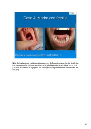 25
LuisRuizGuzmLuisRuizGuzmáán,n,GavGavààSalutSalutFamiliar(Familiar(www.gavasalutfamiliar.comwww.gavasalutfamiliar.com)11)11--XIXI--20112011
Caso 4: Madre con frenilloCaso 4: Madre con frenillo
http://http://www.youtube.comwww.youtube.com//watch?vwatch?v==gmDnksGYB_EgmDnksGYB_E
Niña derivada desde Lleida para intervencion de frenectomía en frenillo tipo 2. La
madre presentaba dificultades en el habla y habia estado 6 años con ortodoncia
y 2 años acudiendo al logopeda sin conseguir correjir del todo las dificultades en
el habla.
 