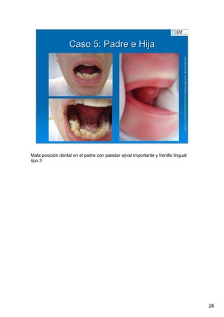 26
LuisRuizGuzmLuisRuizGuzmáán,n,GavGavààSalutSalutFamiliar(Familiar(www.gavasalutfamiliar.comwww.gavasalutfamiliar.com)11)11--XIXI--20112011
Caso 5: Padre e HijaCaso 5: Padre e Hija
Mala posición dental en el padre con paladar ojival importante y frenillo lingual
tipo 3.
 