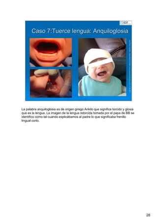 28
LuisRuizGuzmLuisRuizGuzmáán,n,GavGavààSalutSalutFamiliar(Familiar(www.gavasalutfamiliar.comwww.gavasalutfamiliar.com)11)11--XIXI--20112011
Caso 7:Tuerce lengua: AnquiloglosiaCaso 7:Tuerce lengua: Anquiloglosia
La palabra anquiloglosia es de origen girego Ankilo que significa torcido y glosia
que es la lengua. La imagen de la lengua retorcida tomada por el papa de BB se
identifico como tal cuando explicábamos al padre lo que significaba frenillo
lingual corto.
 
