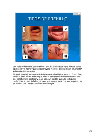 29
LuisRuizGuzmLuisRuizGuzmáán,n,GavGavààSalutSalutFamiliar(Familiar(www.gavasalutfamiliar.comwww.gavasalutfamiliar.com)11)11--XIXI--20112011
TIPOS DE FRENILLOTIPOS DE FRENILLO
I
III
IV
II
Los tipos de frenillo se clasifican del 1 al 4. La clasificación tiene relación con la
apariencia y la forma y pueden dar mayor o menores dificultades en amamantar,
valorando otros aspectos-
El tipo 1 va desde la punta de la lengua a la encia al borde superior, El tipo 2 va
desde la parte media de la lengua hasta la encia mas o menos cefálica El tipo
tres es totalmente posterior y se ve como un cordón que sale de la parte
posterior de la base de la lengua hasta la encia y el tipo 4 que solo se palpa y se
ve una dificultad en la movilización de la lengua.
 