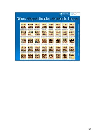 33
LuisRuizGuzmLuisRuizGuzmáán,n,GavGavààSalutSalutFamiliar(Familiar(www.gavasalutfamiliar.comwww.gavasalutfamiliar.com)11)11--XIXI--20112011
NiNiñños diagnosticados de frenillo lingualos diagnosticados de frenillo lingual
CAP El CastellCAP El Castell
CASTELLDEFELSCASTELLDEFELS
 