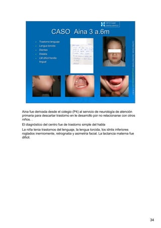 34
LuisRuizGuzmLuisRuizGuzmáán,n,GavGavààSalutSalutFamiliar(Familiar(www.gavasalutfamiliar.comwww.gavasalutfamiliar.com)11)11--XIXI--20112011
CASOCASO AinaAina 3 a.6m3 a.6m
Trastorno lenguajeTrastorno lenguaje
Lengua torcidaLengua torcida
DientesDientes
DislaliaDislalia
LMLM dificildificil frenillofrenillo
linguallingual
CAP El CastellCAP El Castell
CASTELLDEFELSCASTELLDEFELS
Aina fue derivada desde el colegio (P4) al servicio de neurología de atención
primaria para descartar trastorno en le desarrollo por no relacionarse con otros
niños. .
El diagnóstico del centro fue de trastorno simple del habla
La niña tenia trastornos del lenguaje, la lengua torcida, los idntis inferiores
rogtados inerniomente, retrognatia y asimetria facial. La lactancia materna fue
dificil.
 