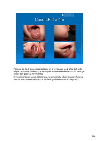 35
LuisRuizGuzmLuisRuizGuzmáán,n,GavGavààSalutSalutFamiliar(Familiar(www.gavasalutfamiliar.comwww.gavasalutfamiliar.com)11)11--XIXI--20112011
Caso LF 2 a 4mCaso LF 2 a 4m
CAP El CastellCAP El Castell
CASTELLDEFELSCASTELLDEFELS
Paciente de 2 a 4 meses diagnosticado en la revisión de los 2 años de frenillo
lingual. Su madre comenta que habla poco aunque lo entiende todo. El se dirige
a ellos con gestos y movimientos.
El hundimiento del centro de la lengua, la retrongnatia y los incisivos inferiores
rotados interiormente así como el frenillo lingual determinan el diagnostico.
 