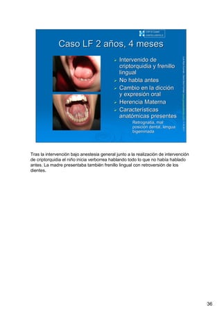 36
LuisRuizGuzmLuisRuizGuzmáán,n,GavGavààSalutSalutFamiliar(Familiar(www.gavasalutfamiliar.comwww.gavasalutfamiliar.com)11)11--XIXI--20112011
Caso LF 2 aCaso LF 2 añños, 4 mesesos, 4 meses
Intervenido deIntervenido de
criptorquidia y frenillocriptorquidia y frenillo
linguallingual
No habla antesNo habla antes
Cambio en la dicciCambio en la diccióónn
y expresiy expresióón oraln oral
Herencia MaternaHerencia Materna
CaracterCaracteríísticassticas
anatanatóómicas presentesmicas presentes
•• Retrognatia, malRetrognatia, mal
posiciposicióón dental, lenguan dental, lengua
bigeminadabigeminada
CAP El CastellCAP El Castell
CASTELLDEFELSCASTELLDEFELS
Tras la intervención bajo anestesia general junto a la realización de intervención
de criptorquidia el niño inicia verborrea hablando todo lo que no había hablado
antes. La madre presentaba también frenillo lingual con retroversión de los
dientes.
 