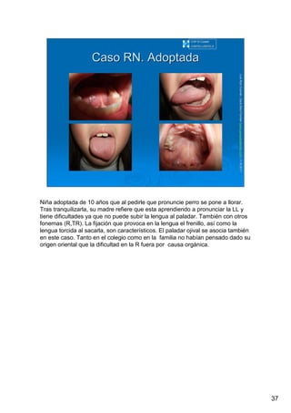 37
LuisRuizGuzmLuisRuizGuzmáán,n,GavGavààSalutSalutFamiliar(Familiar(www.gavasalutfamiliar.comwww.gavasalutfamiliar.com)11)11--XIXI--20112011
Caso RN. AdoptadaCaso RN. Adoptada
CAP El CastellCAP El Castell
CASTELLDEFELSCASTELLDEFELS
Niña adoptada de 10 años que al pedirle que pronuncie perro se pone a llorar.
Tras tranquilizarla, su madre refiere que esta aprendiendo a pronunciar la LL y
tiene dificultades ya que no puede subir la lengua al paladar. También con otros
fonemas (R,TR). La fijación que provoca en la lengua el frenillo, así como la
lengua torcida al sacarla, son característicos. El paladar ojival se asocia también
en este caso. Tanto en el colegio como en la familia no habían pensado dado su
origen oriental que la dificultad en la R fuera por causa orgánica.
 