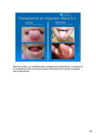 38
LuisRuizGuzmLuisRuizGuzmáán,n,GavGavààSalutSalutFamiliar(Familiar(www.gavasalutfamiliar.comwww.gavasalutfamiliar.com)11)11--XIXI--20112011
FrenectomFrenectomíía en mayores: Maria 5 aa en mayores: Maria 5 a
CAP El CastellCAP El Castell
CASTELLDEFELSCASTELLDEFELS
DESPUDESPUÉÉSS
http://http://www.youtube.comwww.youtube.com//watch?vwatch?v==cqj6X0Gqbhkcqj6X0Gqbhk
ANTESANTES
http://http://www.youtube.comwww.youtube.com//watch?vwatch?v==C5rjznRI5HwC5rjznRI5Hw
Maria de 5 años y su movilidad antes y después de la intervención. La mejoria en
la movilidad asi como en la pronunciacion del fonema R se notaron enseguida
tras la intervencion
 