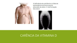 CARÊNCIA DA VITAMINA D
 