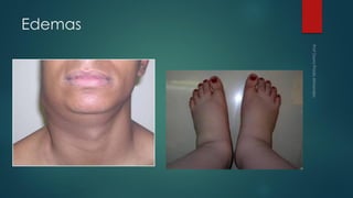 Edemas
 
