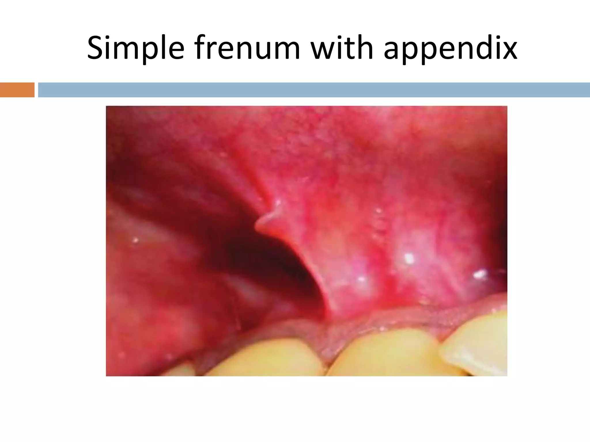 Frenum attachment and it's management. | PPT