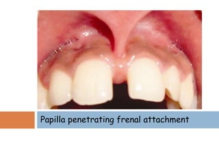 Papilla penetrating frenal attachment
 