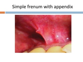 Simple frenum with appendix
 