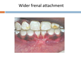 Wider frenal attachment
 